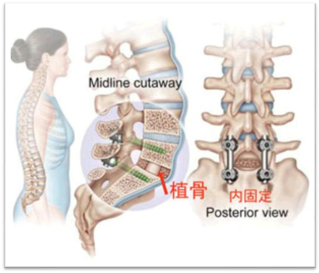 腰椎双侧椎弓根螺钉固定三维有限元分析